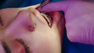 Di adiós al dolor de brackets para siempre: una ortodoncista revela los dos trucos definitivos