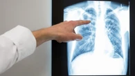 Miles de médicos residentes van a la huelga en Inglaterra para exigir un aumento salarial