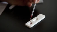 Sanidad reconoce la covid persistente como un problema de salud crónico y prioritario
