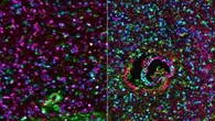 Ensayo clínico pionero revela avances sin precedentes para curar el cáncer cerebral