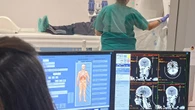 Buscan reclutar pacientes con meningioma recurrente para un ensayo clínico