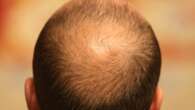 El antibiótico común que podría ser clave en el tratamiento de una rara forma de alopecia