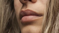 Detienen a dos falsos médicos en Bilbao por practicar la técnica "labios rusos" ilegalmente