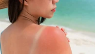 Cómo tratar las quemaduras producidas por el sol durante este verano