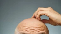 Un dermatólogo lo tiene claro: la calvicie podría tener los días contados