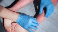Dermatitis atópica en niños: ¿cómo afrontarla?