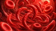 La incertidumbre diaria marca la vida de los pacientes con enfermedad de células falciformes