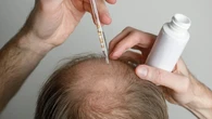 El 'azúcar' que detiene la calvicie: es igual de efectivo que el minoxidil y más barato, según un estudio