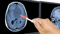 Un estudio vincula la testosterona a una mayor supervivencia en glioblastoma