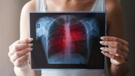 Clarisse pone cifras al aumento del cáncer de pulmón en mujeres
