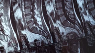 ¿Podría ser el TAC lumbar el nuevo cribado de la osteoporosis?