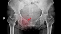 Osteoporosis: cuando una fractura puede no venir sola