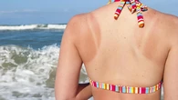La tanorexia, una adición al bronceado que afecta más a las mujeres jóvenes
