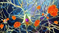 El análisis de sangre permite estimar el riesgo de Alzheimer hasta una década antes de los primeros síntomas