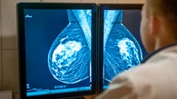 La IA detecta señales de cáncer de mama hasta seis años antes del diagnóstico