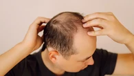 Un estudio revela la solución para combatir la calvicie: igual de efectivo que el minoxidil y más económico