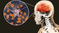 La meningitis aumenta en España: cómo prevenir la enfermedad que puede causar la muerte en cuestión de horas