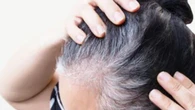 ¿Se te cae el pelo o es 'Shedding'? Los expertos te lo explican