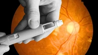 Dos investigaciones confirman que los fármacos contra la obesidad tipo Ozempic aumentan el riesgo de "infarto" ocular incremento de sufrir una rara patología ocular