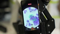 El uso de antibióticos reduce un 20% la supervivencia en pacientes con este cáncer