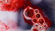 Mieloma múltiple: el cáncer de la sangre que afecta a mayores de 65 años, incurable pero tratable
