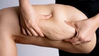 Cómo tratar el lipedema: terapias innovadoras para reducir dolor y recuperar movilidad