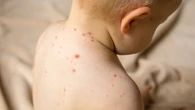 Esta es la enfermedad "extremadamente infecciosa" que ha puesto en jaque a un importante aeropuerto en Estados Unidos