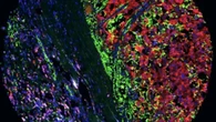 Científicos españoles dan con una nueva vía para reducir la metástasis del melanoma