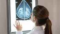 Confirman un nuevo factor para personalizar la quimio adyuvante en cáncer de mama