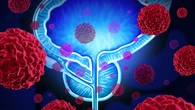 ¿Cómo convivir con el cáncer de próstata? Un manual práctico para pacientes da las claves