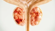 Revelan cómo detener la forma más letal del cáncer de próstata