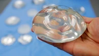 Al menos 111 mujeres han sufrido linfoma por los implantes mamarios en España