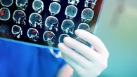¿Una lesión que aumenta tras la radioterapia es un tumor activo o un efecto secundario?