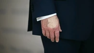 Qué le pasa a Donald Trump en las manos y qué se sabe sobre su salud