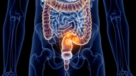 Claves para detectar cáncer colorrectal