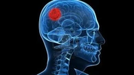 El glioma de bajo grado provoca una pérdida de productividad de más de 16.000 euros en pacientes y familiares al año
