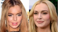 He probado el láser que se ha hecho Lindsay Lohan y los resultados son sorprendentes