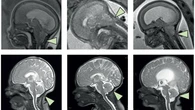 Descubren una hormona en nuestro cerebro que revierte la obesidad