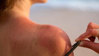 Ni todos los melanomas se desarrollan en la superficie cutánea ni el bronceado protege: estos son los mitos del verano sobre el cáncer de piel