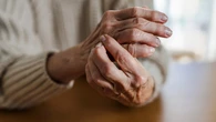 Un fármaco reduce el riesgo de desarrollar artritis reumatoide, según un ensayo clínico
