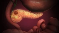 Un análisis de sangre ultrasensible detecta el cáncer de páncreas oculto