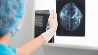 Así es MamoRisk, el estudio que calculará el riesgo de cáncer de mama de cada mujer