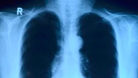 ¿Es posible usar donantes mayores de 70 años para el trasplante de pulmón? La ciencia lo aclara