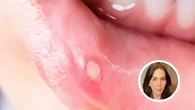 ¿Por qué salen llagas en la boca? Esta médica especialista en endocrinología lo explica