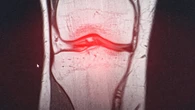 España, primer país en aplicar un innovador tratamiento para la artrosis de rodilla