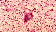 Paso de gigante para encontrar el primer tratamiento contra el sarampión del mundo