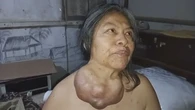 Extirpan en Madrid un tumor gigante que asfixiaba a una mujer tras 38 años creciendo en su cuello