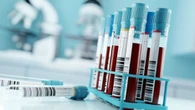 Día Mundial de la Hemofilia: ¿qué es esta enfermedad y cuál es su tratamiento?