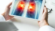 Un signo poco común en los dedos puede ser una advertencia temprana de cáncer de pulmón