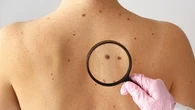 Un virus común puede mejorar la respuesta al melanoma metastásico una enfermedad con 300.000 personas diagnosticadas cada año